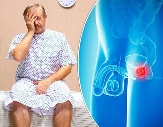 Symptômes de la prostatite